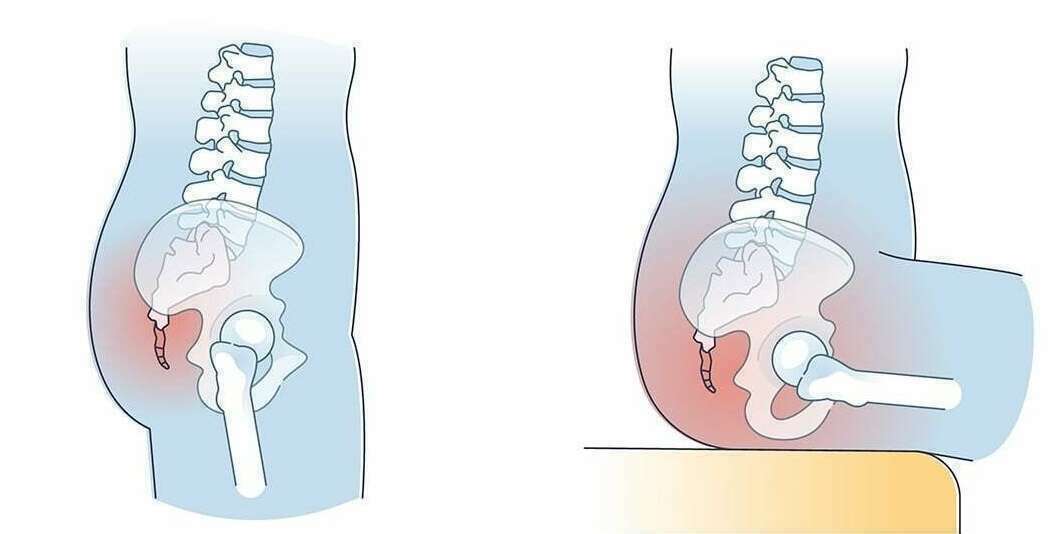 Zone du coccyx, au bas de la colonne, en position assise